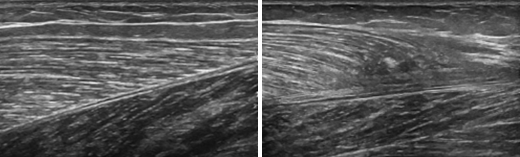 Achilles+tendonitis+ultrasound